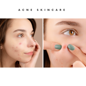 Acne Treatment Fast in 5 Days